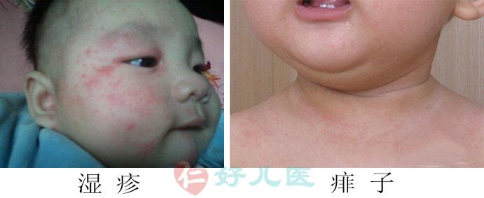 湿疹和痱子的区别.jpg