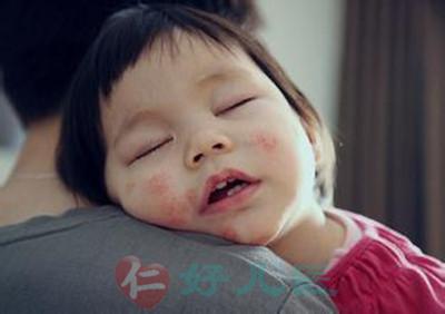 对小儿湿疹的思考.jpg