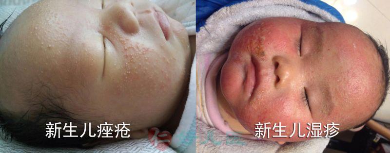 新生儿痤疮与湿疹对比800.jpg 新生儿痤疮与湿疹对比800.jpg