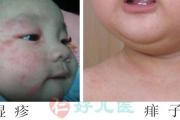 湿疹和痱子的区别有这四点