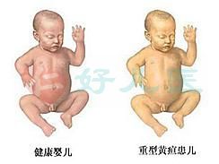 新生儿黄疸.jpg
